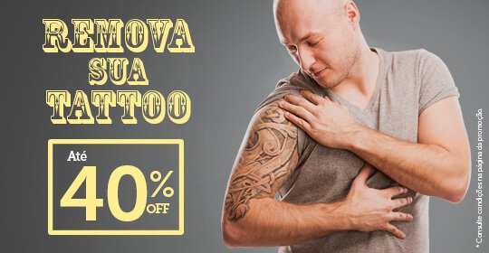 Remova sua tattoo com até 40% de desconto