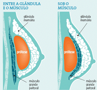 Prótese de Silicone tem prazo de validade?