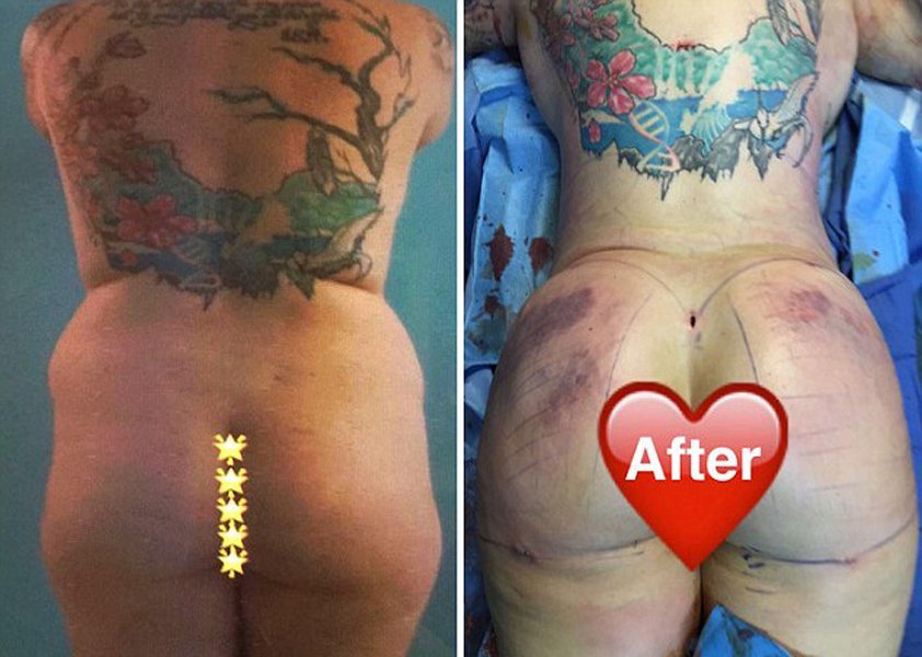 Cirurgião mostra pelo Snapchat como deixar mulher com bumbum de Nicki Minaj