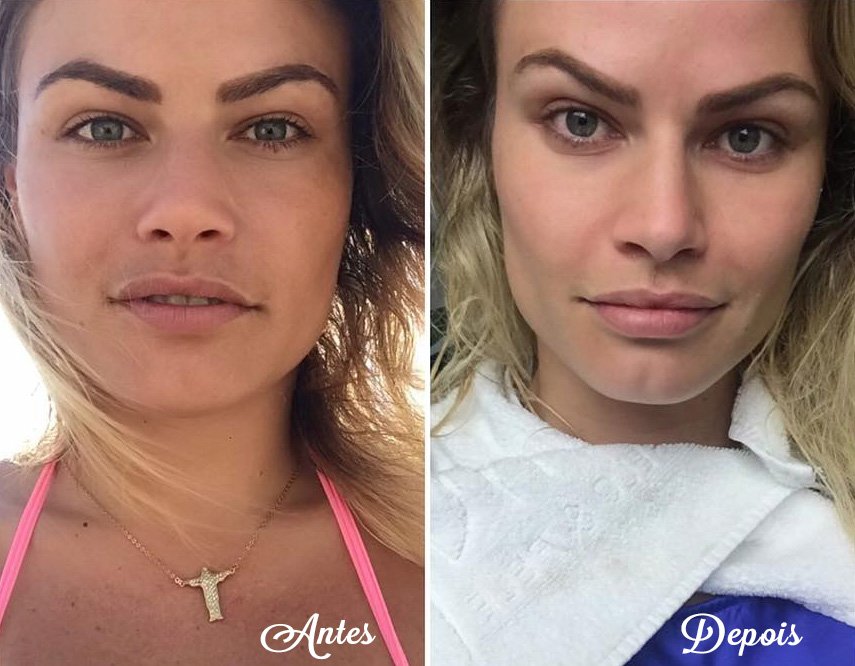 Natalia Casassola mostra antes e depois de sua bichectomia