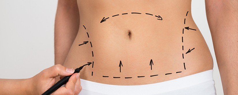 Miniabdominoplastia ou Abdominoplastia: Entenda a diferenca