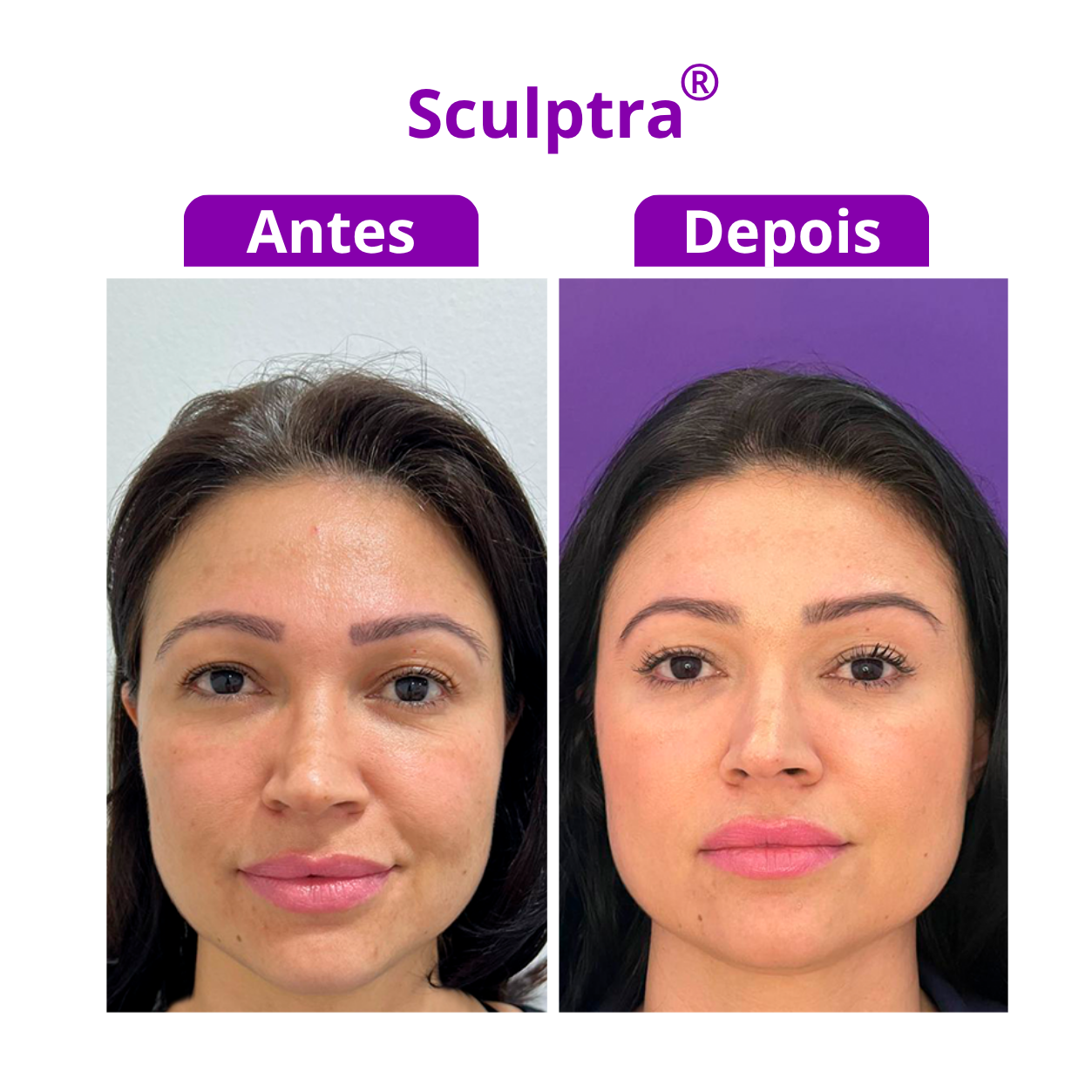 Sculptra