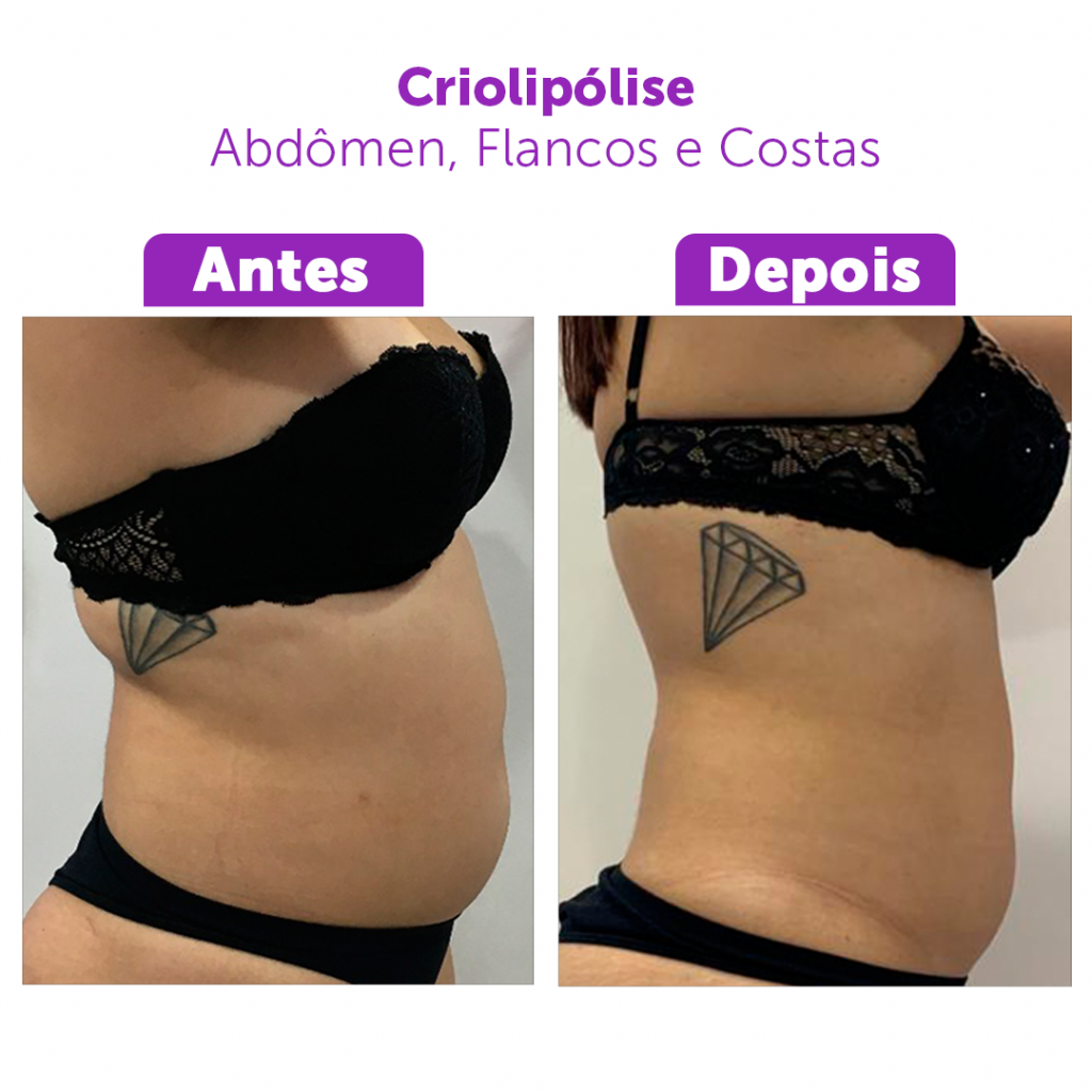 antes-e-depois-criolipolise | Pró-Corpo Estética Avançada
