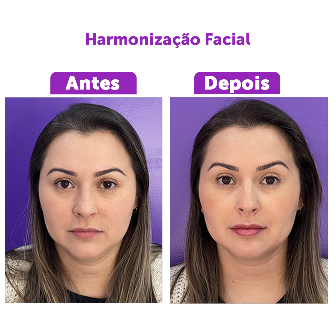 Harmonização Facial