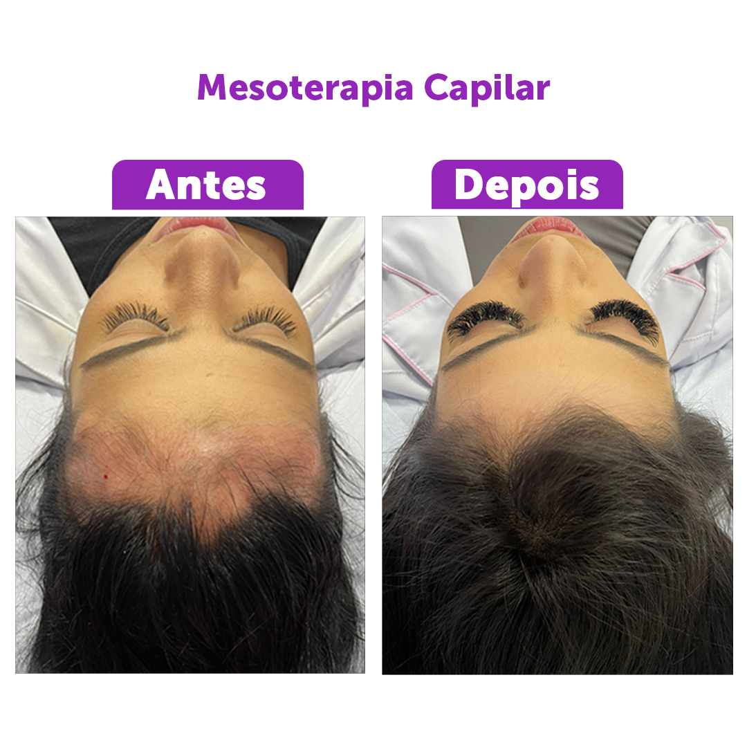 Mesoterapia