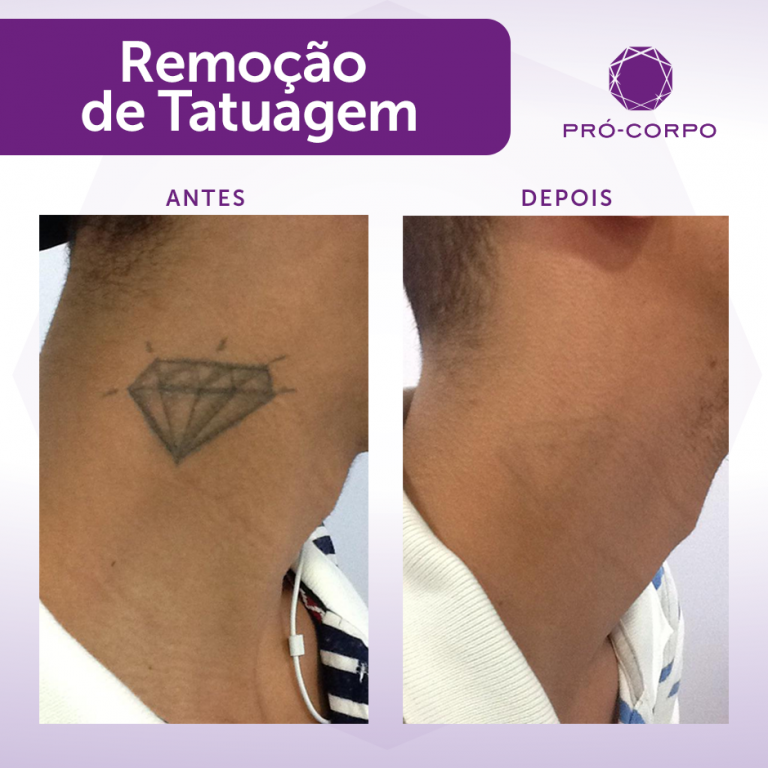 Remoção de Tatuagem - Foto de Antes e Depois
