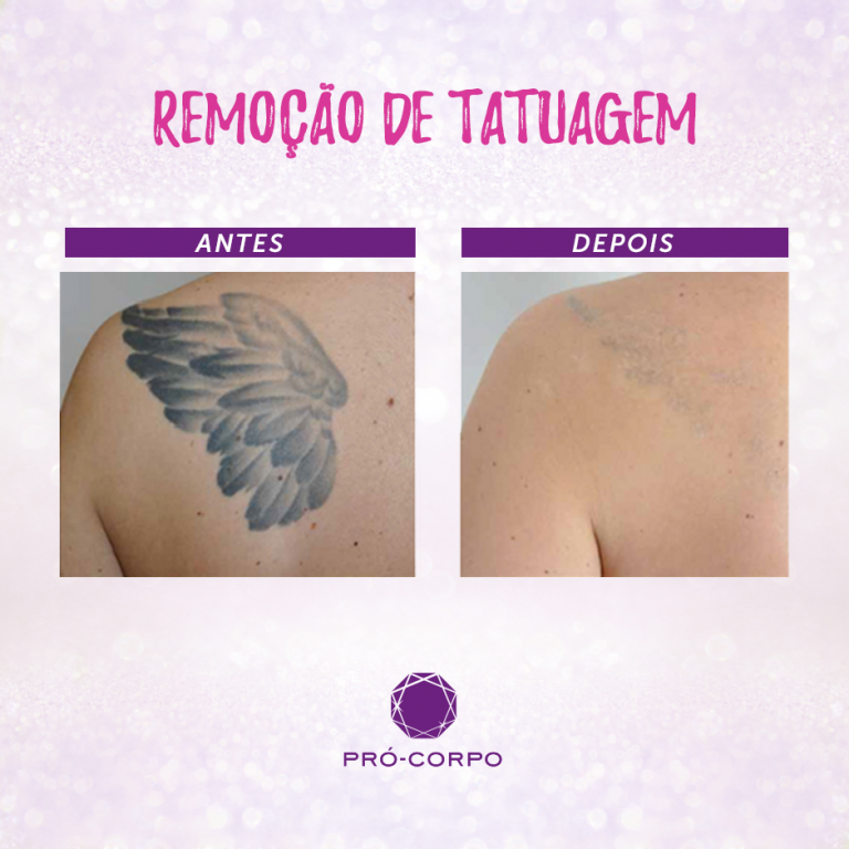 Remoção de Tatuagem