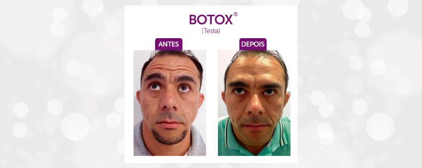 Botox