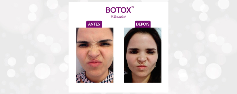 Botox Glabela