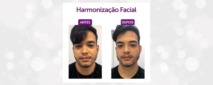 Harmonização Facial