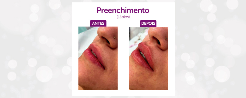 Preenchimento Labial