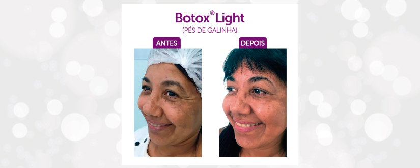 Botox Pés de Galinha