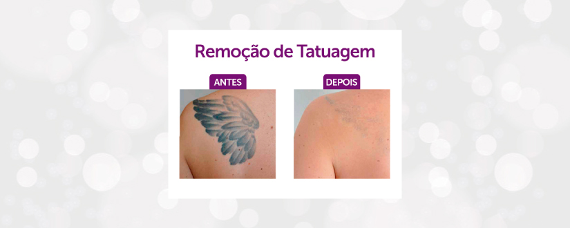 Remoção de tatuagem