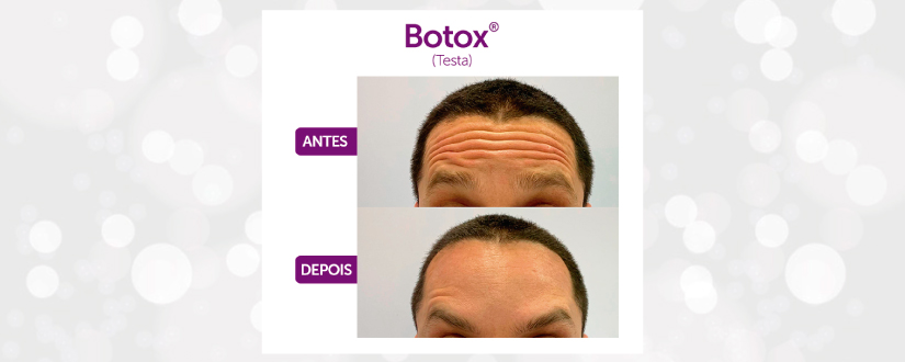 Botox Testa