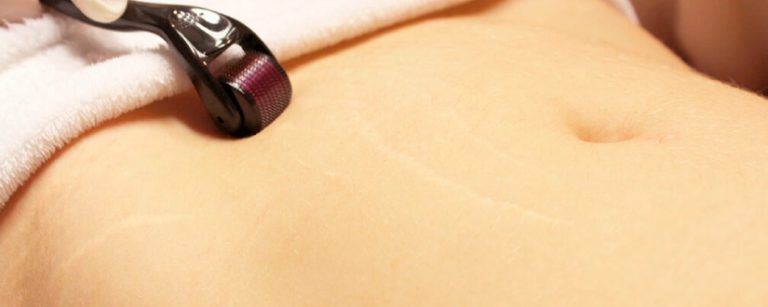 Remoção de tatuagem