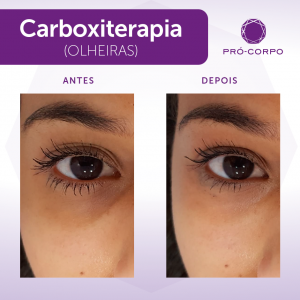 antes e depois do tratamento de olheiras com carboxiterapia