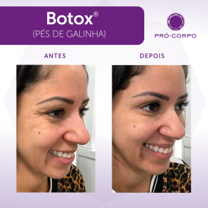 botox- pes de galinha