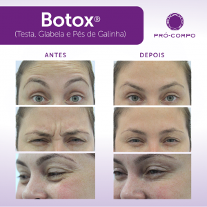 rugas- botox