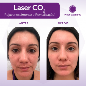 laser-co2-antes-depois-procedimentos-inverno