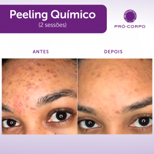 peeling-quimico