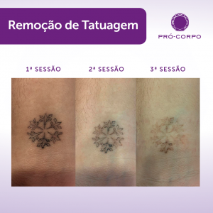 remoção-tattoo 