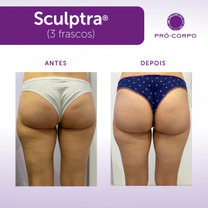 sculptra gluteos