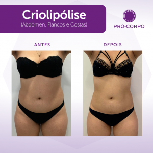 criolipolise-antes-depois-procedimentos-inverno