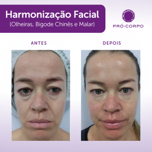 harmonização facial - tratamento 