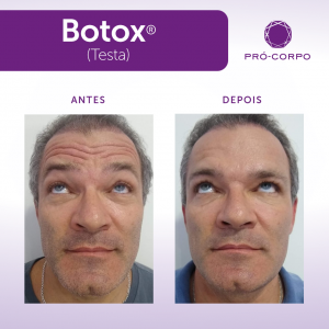 botox-masculino-antes-depois