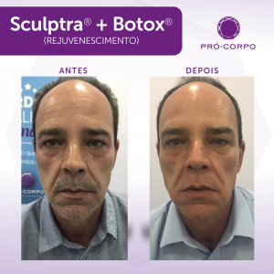 sculptra-facial-antes-depois