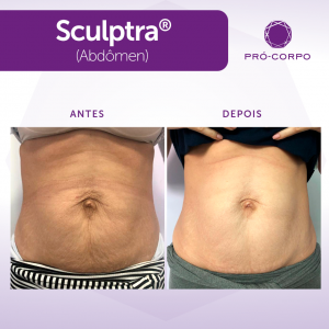 sculptra procedimento que estimula o colágeno melhorando a flacidez do corpo 