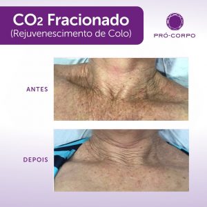 Cuidados com a pele após a aplicação do Laser de Co2 fracionado do rejuvenescimento de colo 