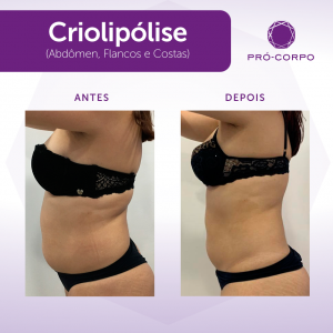 criolipolise antes e depois região do abdomen flancos e costas 