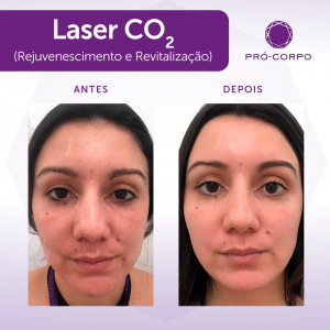 Cuidados com a pele após a aplicação do Laser de Co2 fracionado para rejuvenescimento e revitalização 