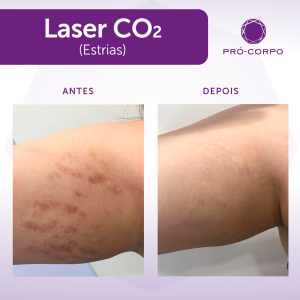 Cuidados com a pele após a aplicação do Laser de Co2 fracionado indicação para estrias