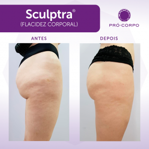 sculptra-coxas