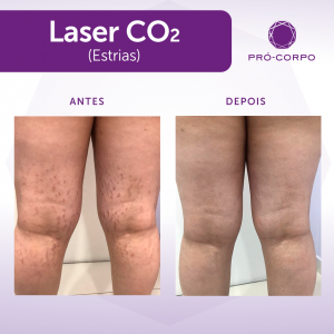 procedimento de Laser Co2 fracionado para estrias