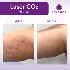 procedimento de Laser Co2 fracionado para estrias