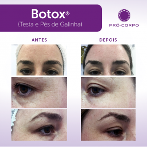 botox light procedimento indicado para amenizar as linhas e marcas de expressão, primeiros sinais que a pele esta envelhecendo 