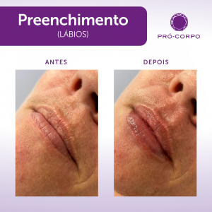 Preenchimento Labial para Hidratar 