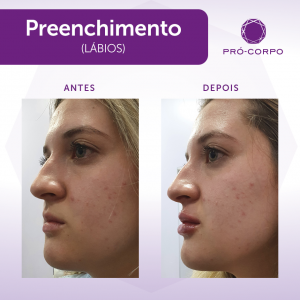 antes e depois do Preenchimento Labial para projeção 