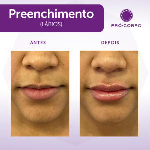 Preenchimento Labial para contorno