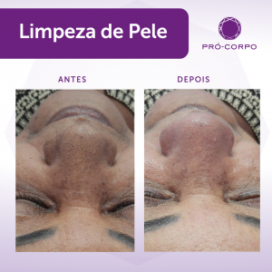 Acne Solar- antes e depois de Limpeza de Pele profunda 