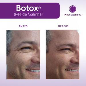 Botox antes e depois pés de galinha