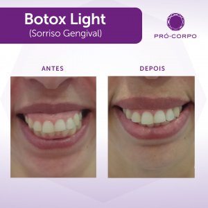 Botox antes e depois sorriso gengival