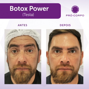 Botox antes e depois na testa