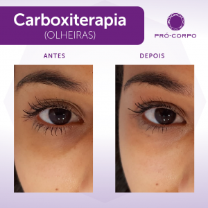 Carboxiterapia olheiras