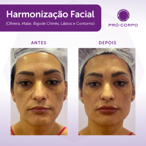 Harmonização Facial Feminino 