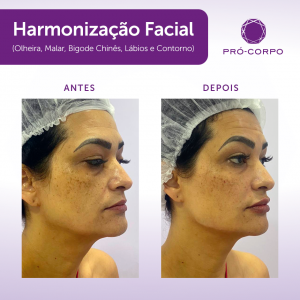 Harmonização Facial Feminino 