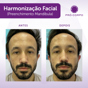 Harmonização Facial Preenchimento Malar